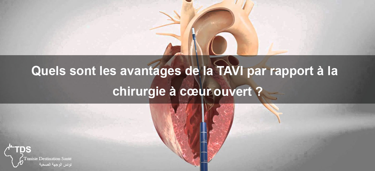 Avantages TAVI