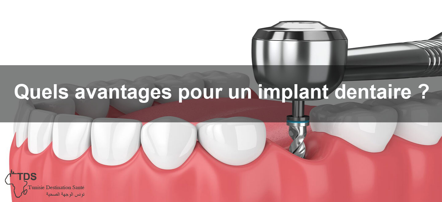 avantages implant dentaire