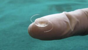 lentille intraoculaire