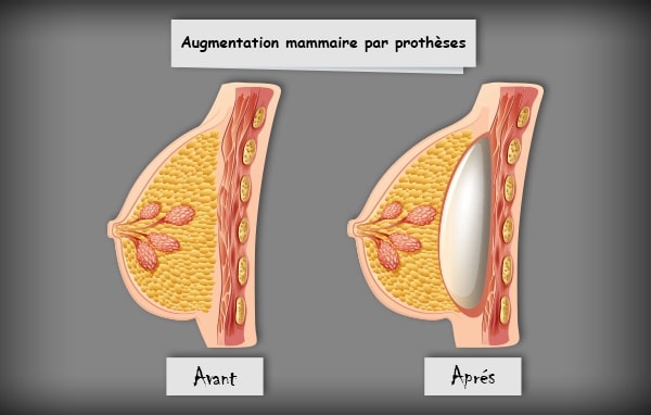 augmentation mammaire