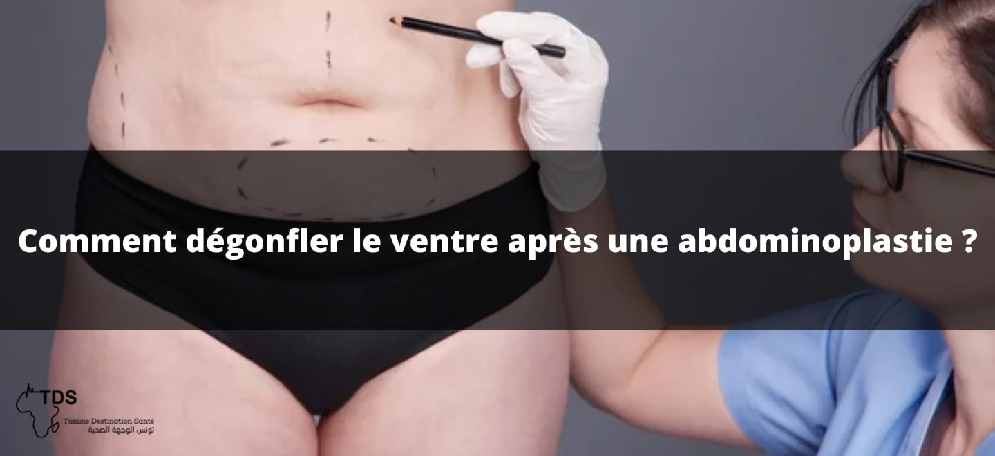 abdominoplastie