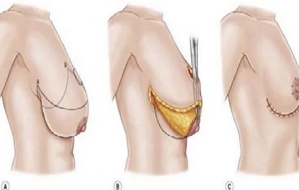 ptose mammaire