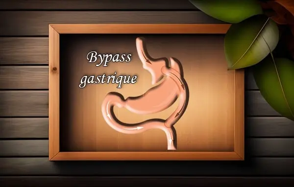 bypass gastrique