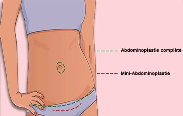 abdominoplastie