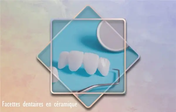 Facettes dentaires céramique