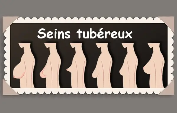 Seins tubéreux