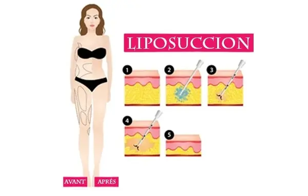 Liposuccion