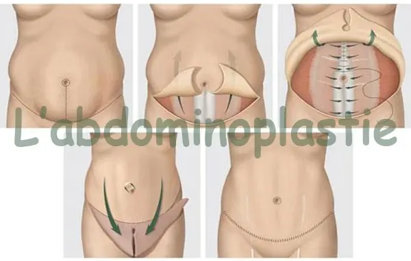 L'abdominoplastie