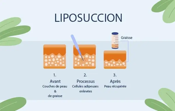 liposuccion