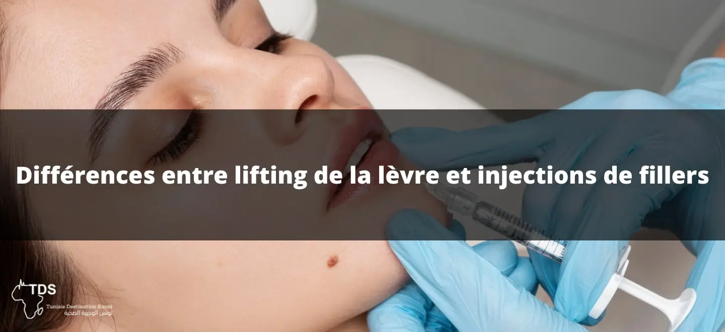 lifting de la Lèvre