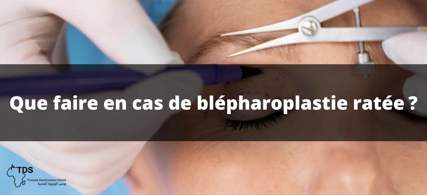 Blépharoplastie