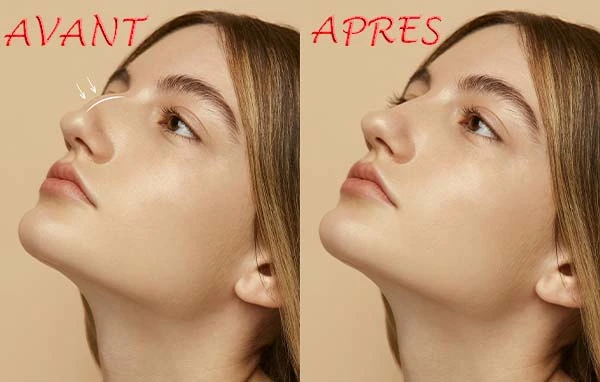 Rhinoplastie