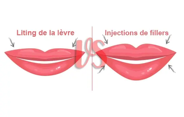 lifting de la Lèvre