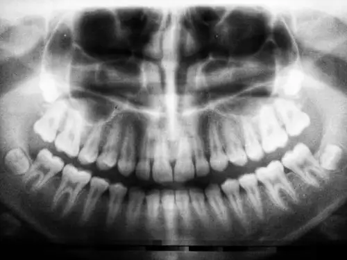 Un implant dentaire