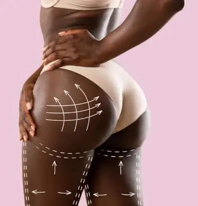 Brazilian Butt Lift (BBL) : Découvrez l'Intervention et ses Avantages