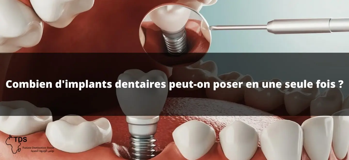 Implants Dentaires