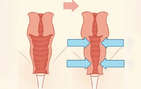 Vaginal