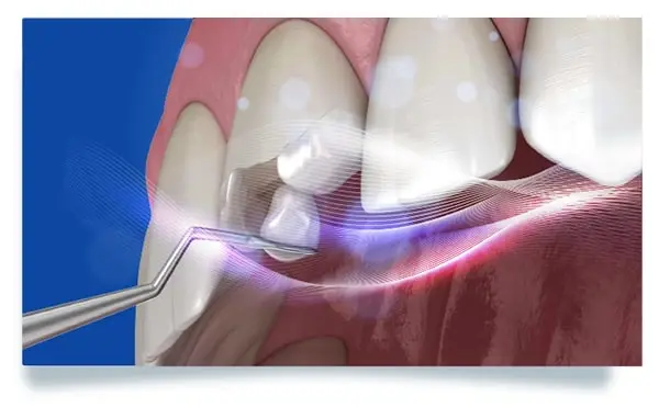 Dents 