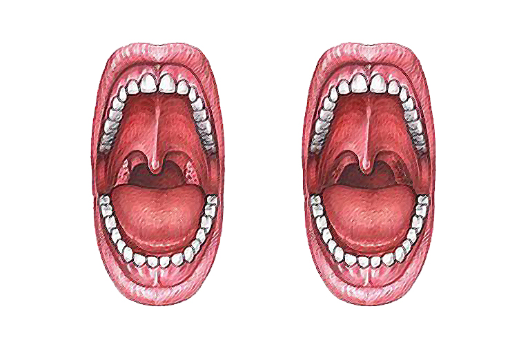 Ablation des Amygdales