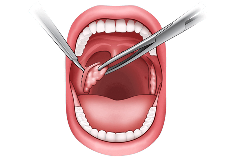 Ablation des Amygdales