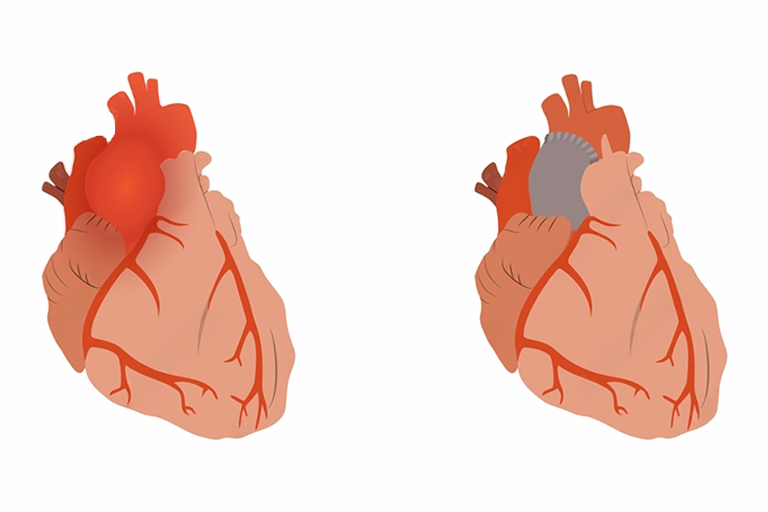 Angioplastie