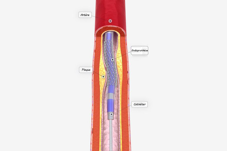 Angioplastie