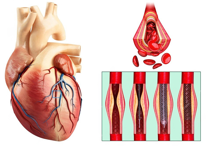Angioplastie