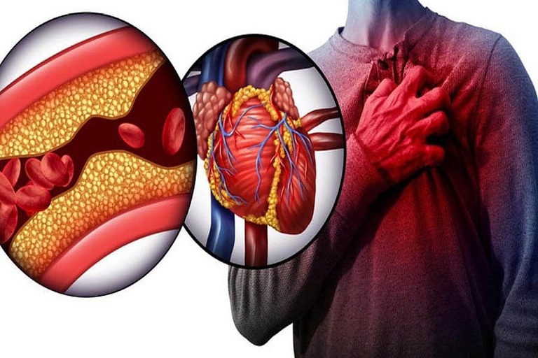 Angioplastie