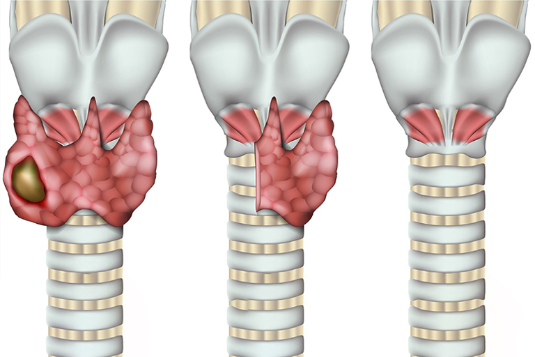 Cancer de la Thyroide