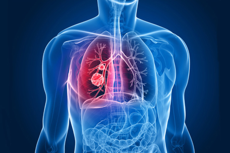 Lobectomie pulmonaire