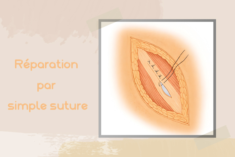 chirurgie pariétale