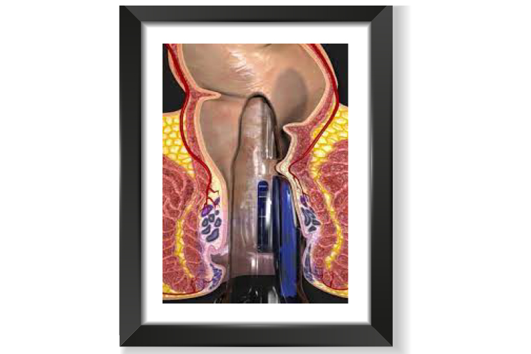 chirurgie proctologique