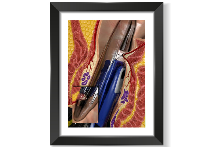 chirurgie proctologique