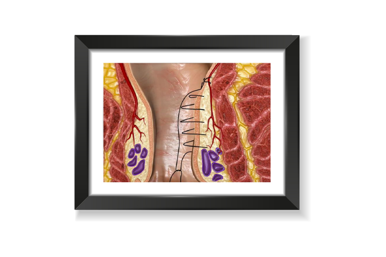 chirurgie proctologique