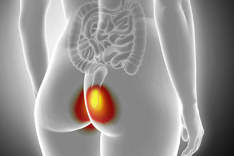 chirurgie proctologique