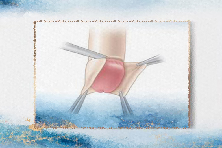 Circoncision adulte