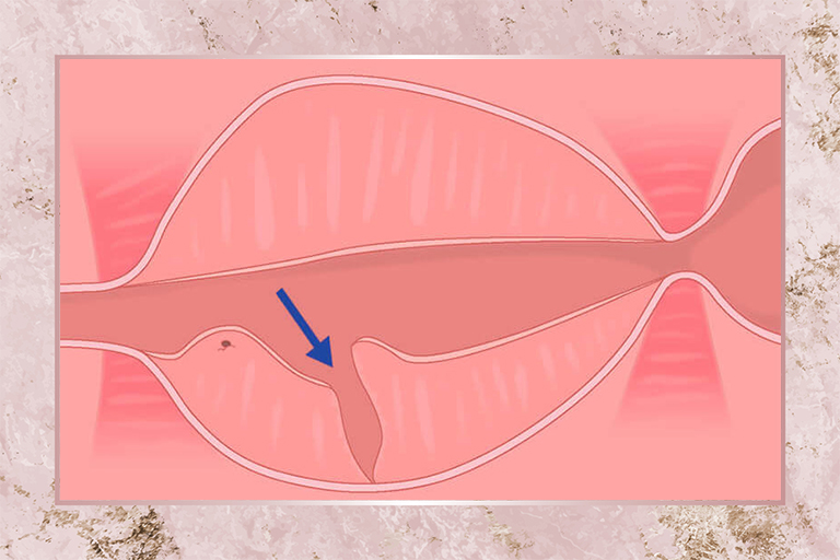 Enucléation prostatique au plasma