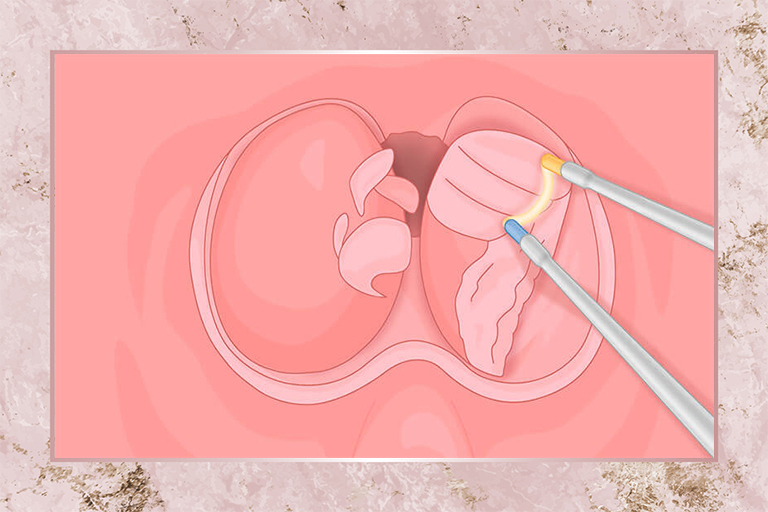 Enucléation prostatique au plasma