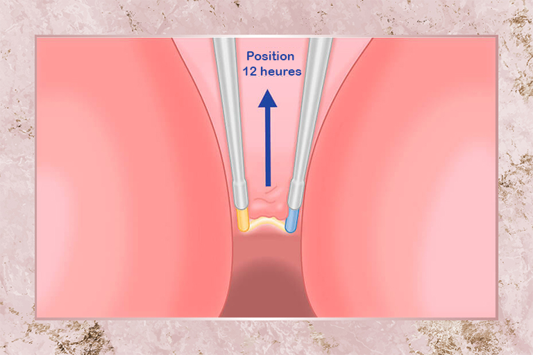 Enucléation prostatique au plasma