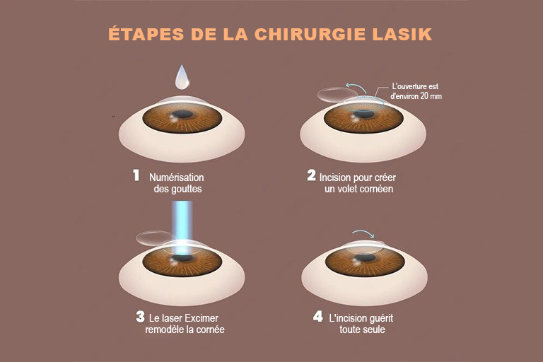 Lasik
