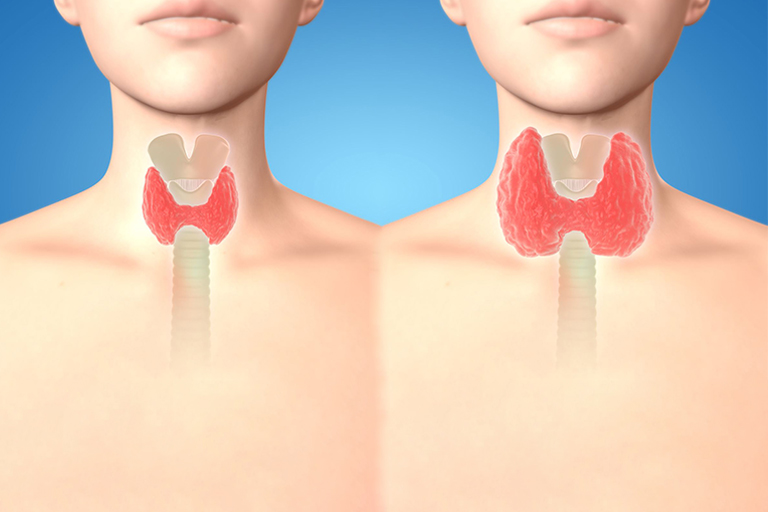 chirurgie de la thyroide