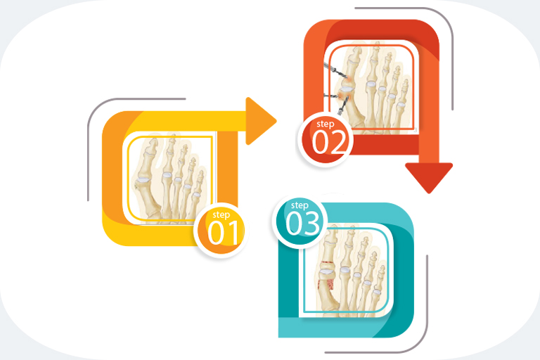 Hallux Valgus