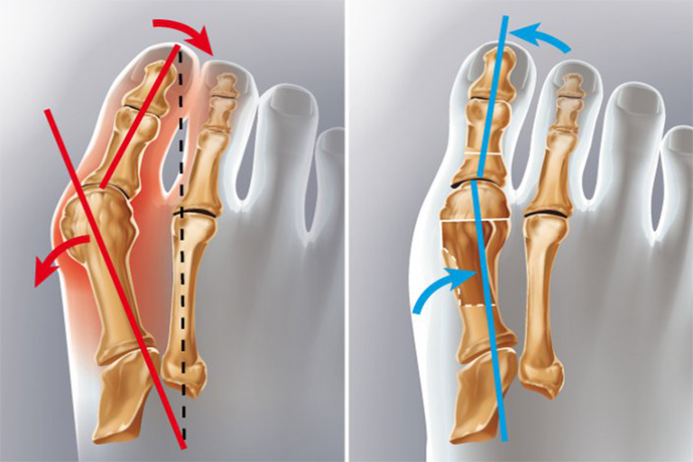 Hallux Valgus