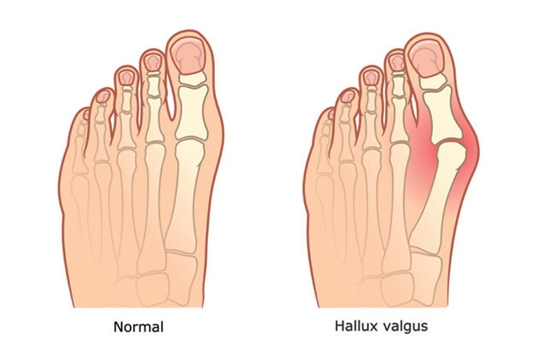 Hallux Valgus