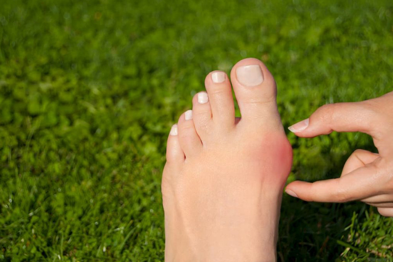 Hallux Valgus