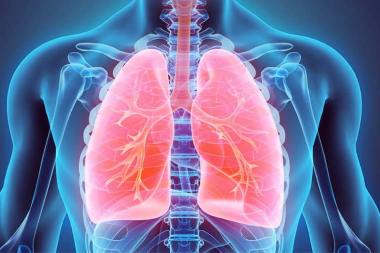 La pneumonectomie
