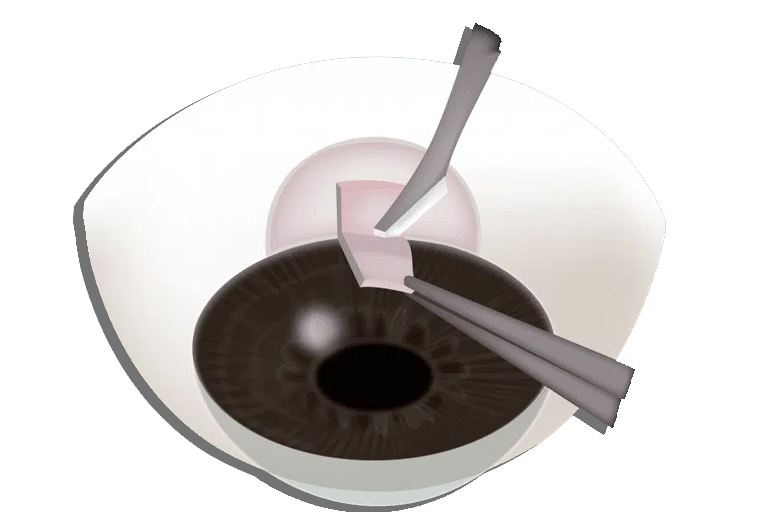 Trabeculectomie