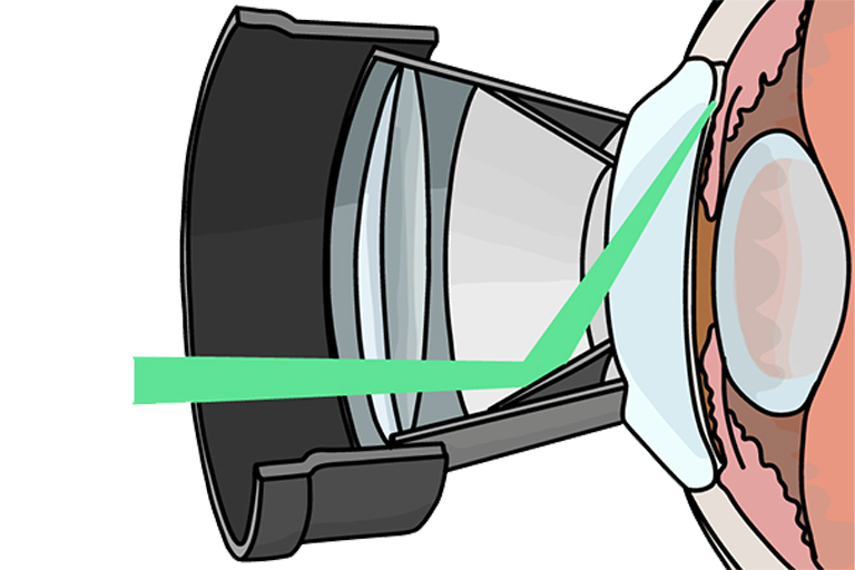 Laser SLT