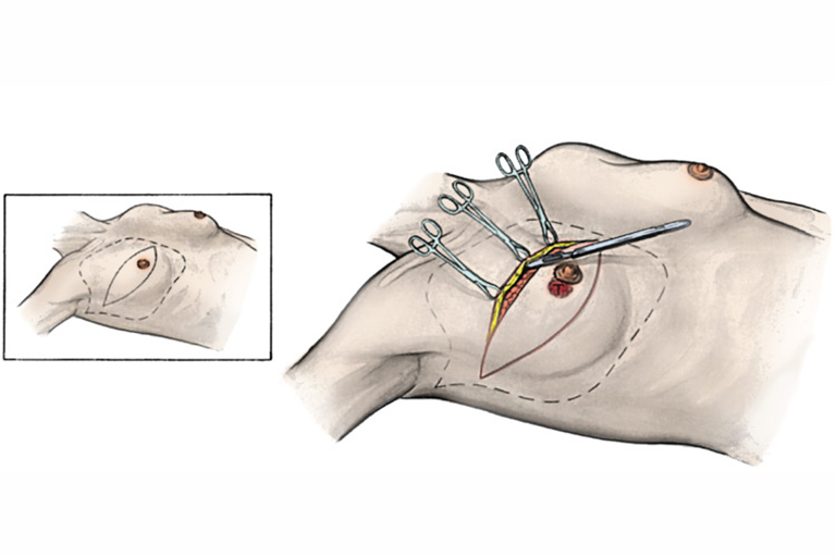 Mastectomie