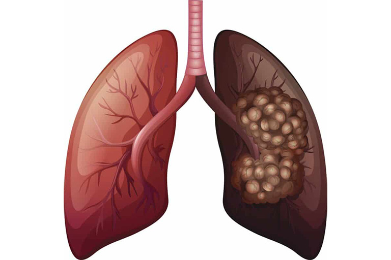La pneumonectomie
